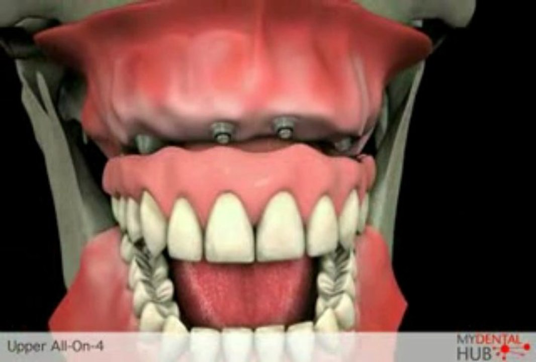 Upper Arch Restoration With All On 4 Dental Implants In Chicago