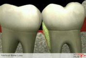 Dr. Irfan Atcha, All On 4 Implant Dentist Chicago Presents Educational Video