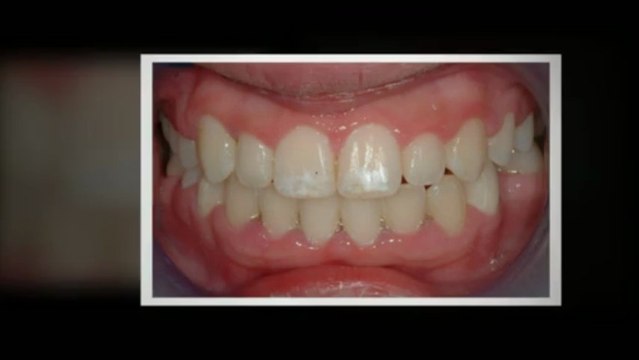 Invisalign Littleton Feb2013