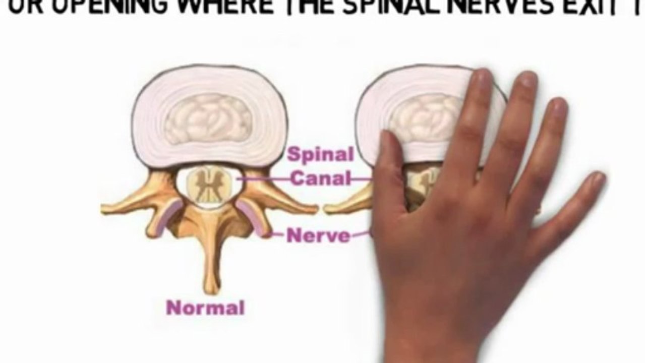 Chiropractor in Back Bay MA - Spinal Stenosis