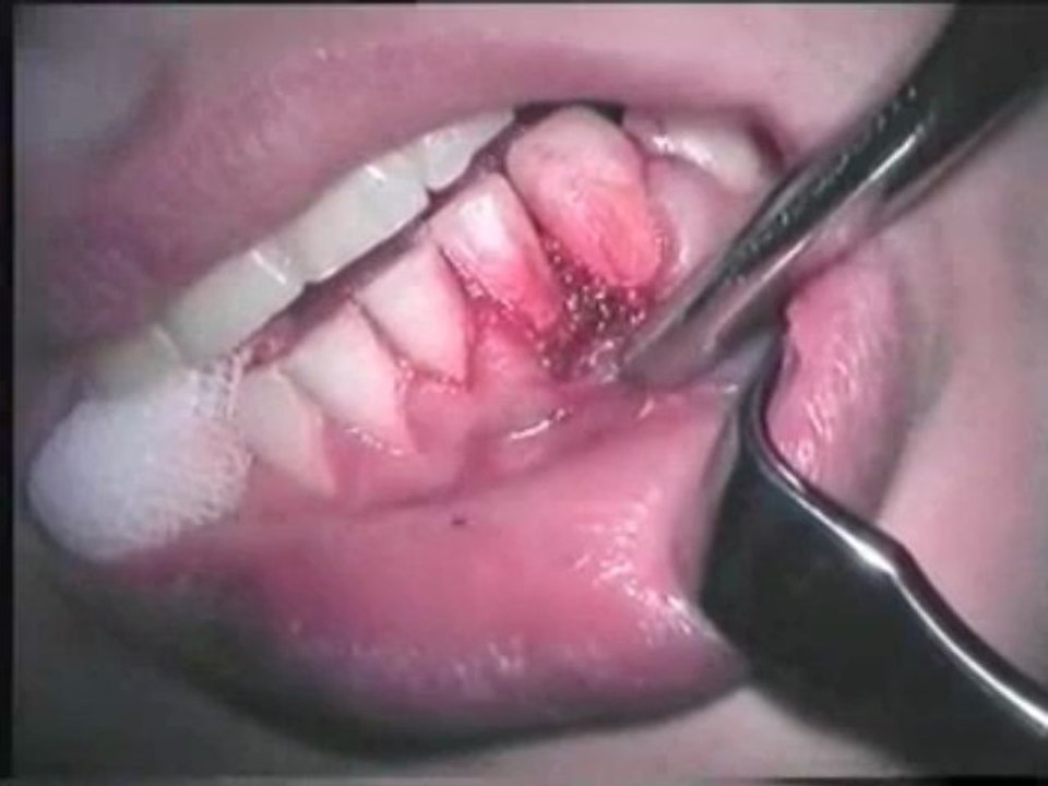Dr Abid Faqir - dental laser operation- Dr Abid Faqir
