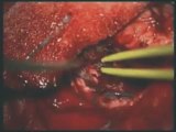 Gerald Schell MD - Waterjet Dissection in Neurosurgery