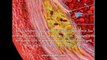 Atherosclerosis And Cholesterol - What Is The Link Between Atherosclerosis And Cholesterol?