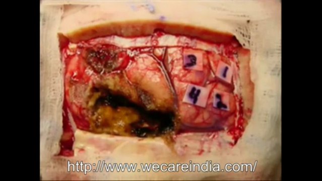 Cost of brain tumor surgery in India