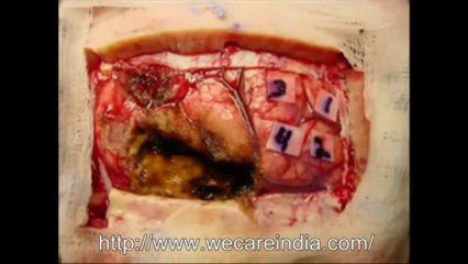 Cost of brain tumor surgery in India