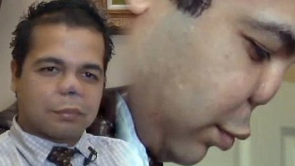 Botched Rhinoplasty Leaves Man Without a Nose