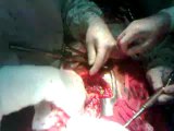 Emergency Cardiac Surgery (Stab injury to heart)