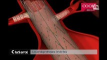 C La Santé : L'Anévrisme de l'Aorte, quels traitements ?