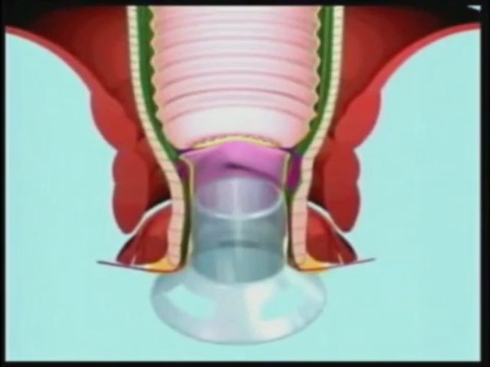 Piles Doctor Pune | Piles Hospital Pune| Piles Treatment in Pune by  Healing Hands Clinic