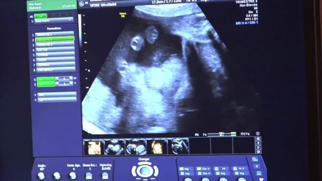 Echographie du 2ème trimestre en 3D Vidéo Dailymotion
