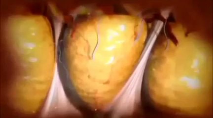 How Velashape Works 🔍