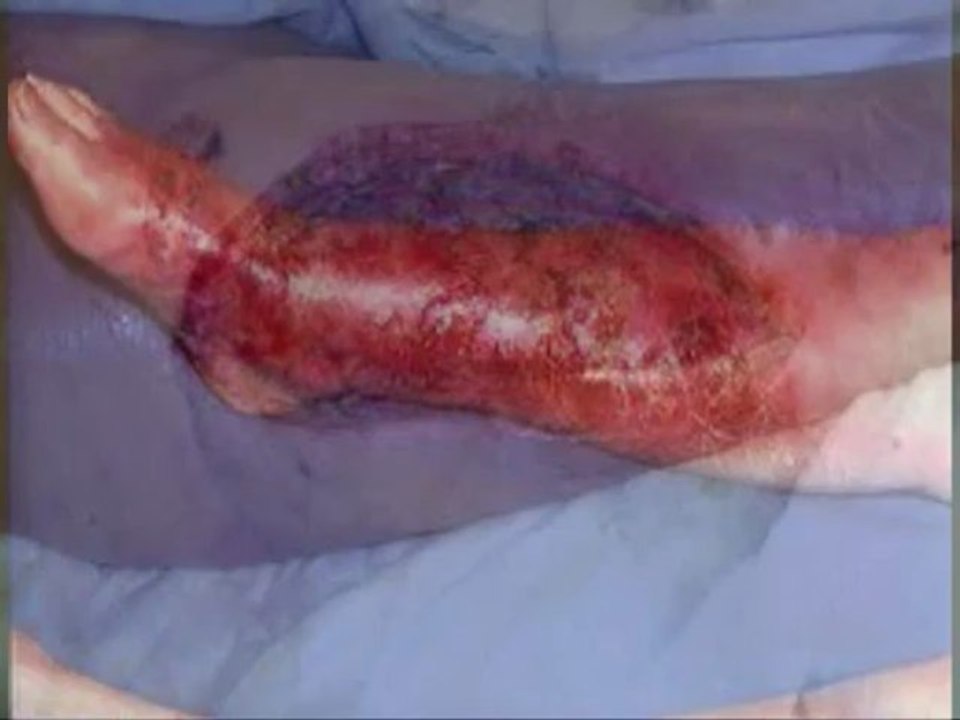 Staph Infections Secrets, Ultimate Guide to get rid of MRSA