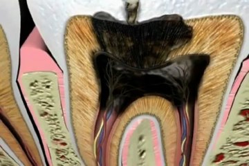 Abid Faqir - What Causes a Tooth Ache- Abid Faqir