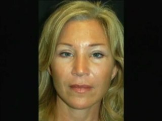 Dr Jason Diamond -- Miraculous Midface Rejuvenation