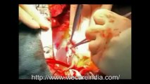 Bypass surgery In India At Low Cost