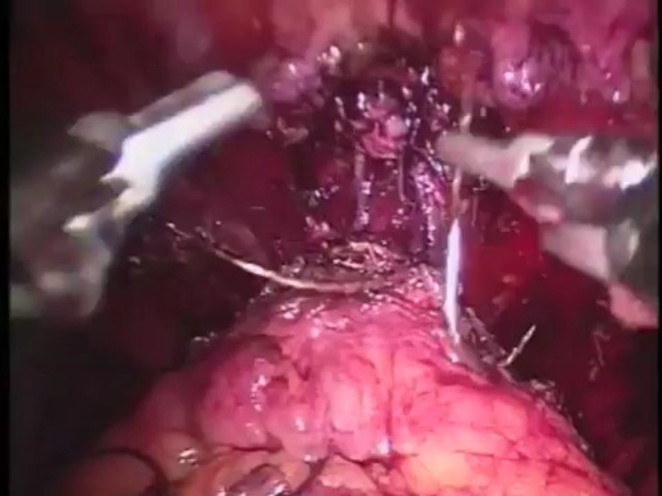 Weill Cornell Robotic Prostatectomy: Nerve Sparing Prostate Cancer Surgery