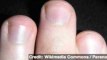 Hope for Human Limb Regeneration Could Lie in Fingernails