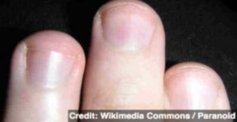 Hope for Human Limb Regeneration Could Lie in Fingernails