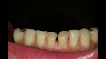 Sydney Cosmetic Dentists - Smile Concepts - Porcelain Veneers, Implants,