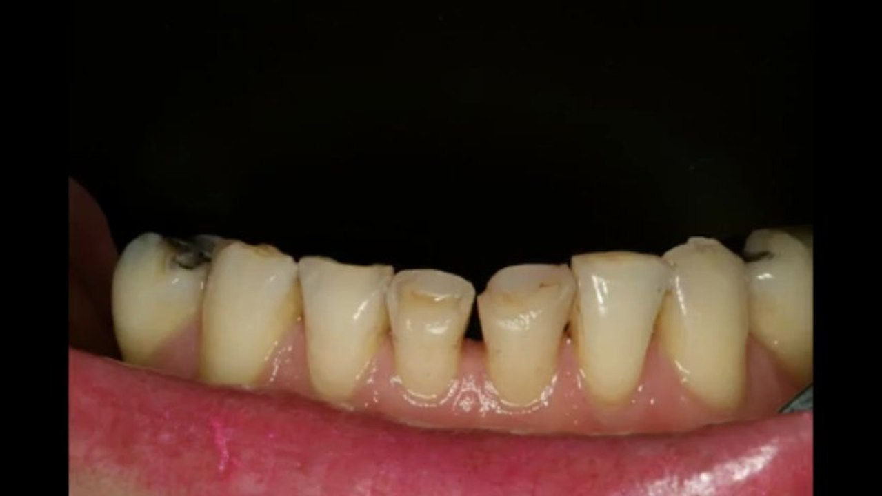 Sydney Cosmetic Dentists - Smile Concepts - Porcelain Veneers, Implants,