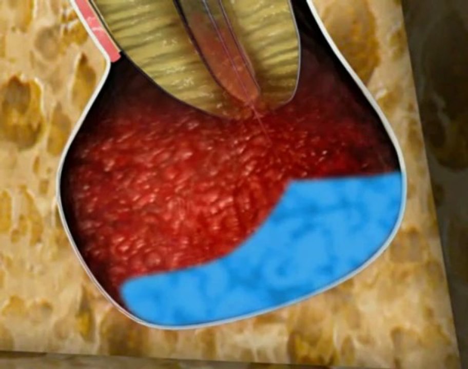 Dr Rodney Aziz - The Apexum Procedure- root canal treatment