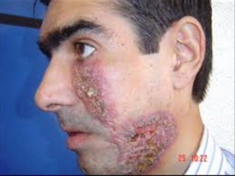 acne during pregnancy|acne scar cream|acne clothing|acne rosacea