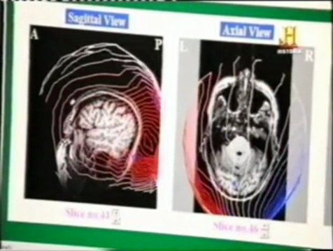 Pareidolia: Cerebro y percepcion de caras (MEG)