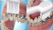Brossage des dents avec un appareil dentaire