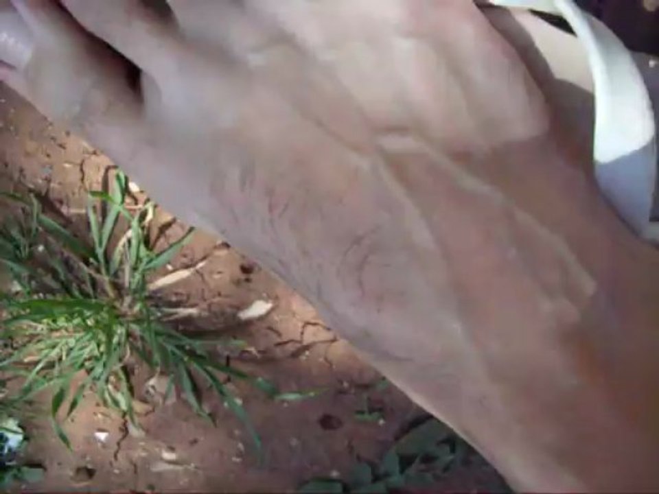 Microcontracture au pieds