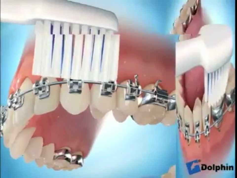 Brossage des dents avec des brackets