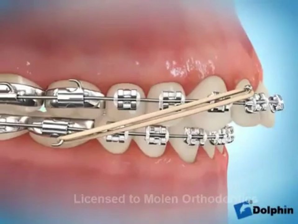 orthodent élastique inter-maxillaire