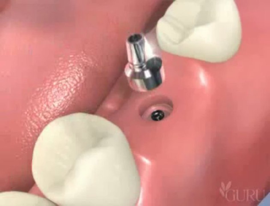 Technique d'implant Molaire