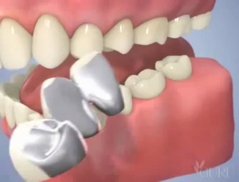 orthodent Pose de bridges en céramique