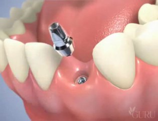 dentiste chirurgie Pose d'un implant en 2 temps (incisive)