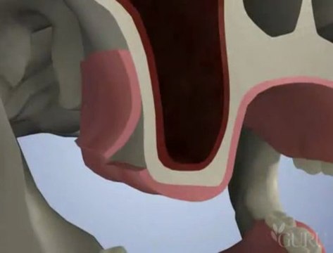 dentiste chirurgien Sinus Lift - Greffe osseuse sinusienne