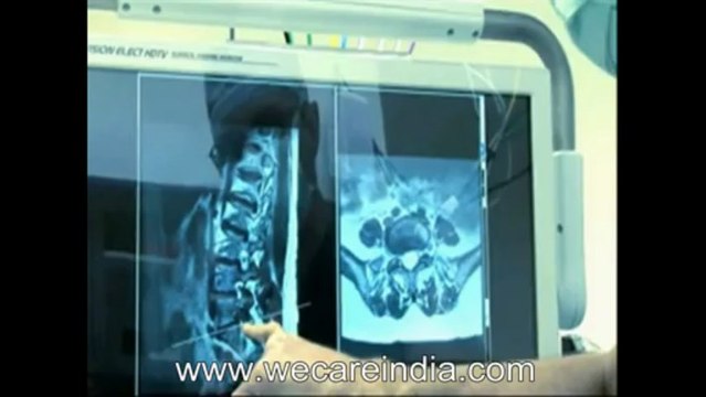 Spine surgery in Mumbai-Cost of The Spine Surgery In India