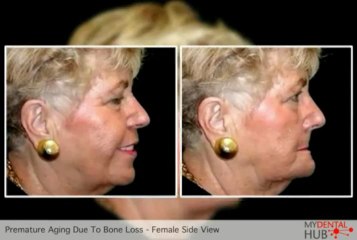 Chicago Implant Dentist Presents Premature Aging Caused By Bone Loss