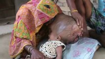Indian surgeons reconstruct baby's swollen head