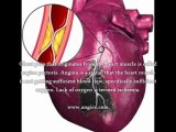 Angina Pectoris With Myocardial Infarction - What Is The Best Treatment For Angina Pectoris With Myocardial Infarction?