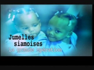Jumelles siamoises : la grande opération