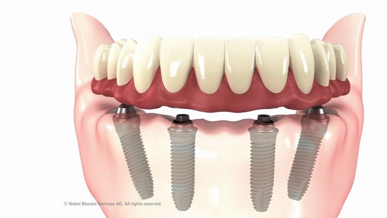 New Jersey Dental Implants Done The "MALO Clinic Way" Using All-On-4 Dental Implants