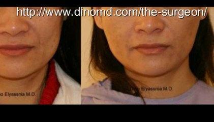 Bay Area plastic surgeon Dr. Dino Elyassnia