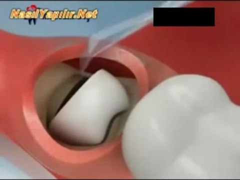 20'lik Diş Çekimi Nasıl Yapılır