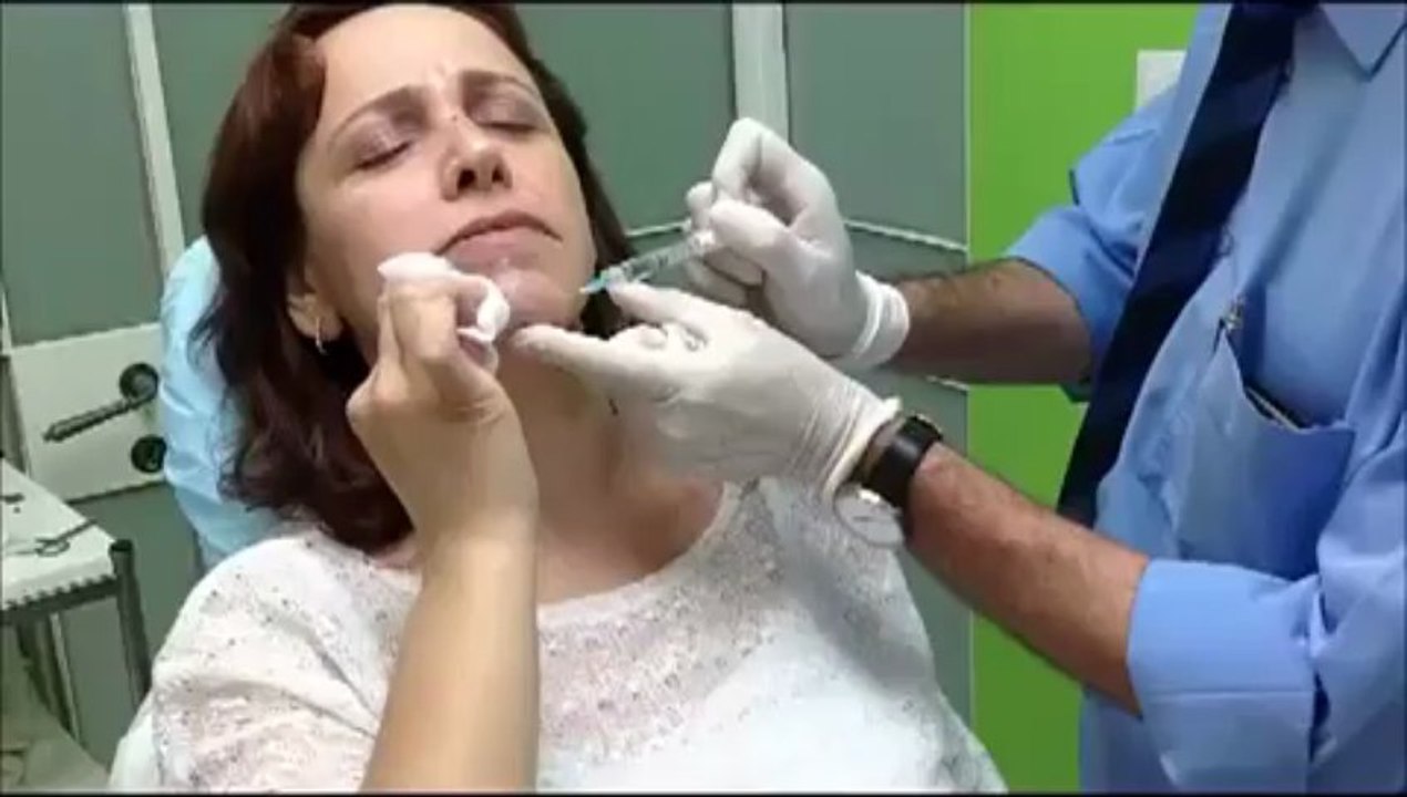 פיסול הפנים על ידי חומצה היאלורונית