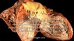 Coronary Artery Disease vs Myocardial Infarction - What Is The Best Treatment For Coronary Artery Disease And Myocardial Infarction?