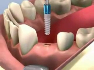 Dentiste low cost - pose d'implant dentaire