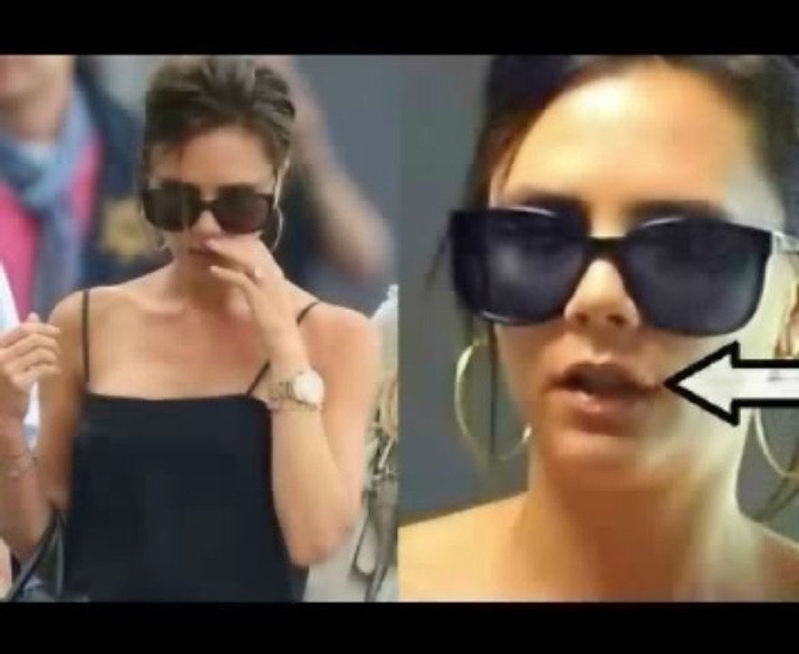 Celebrities with herpes