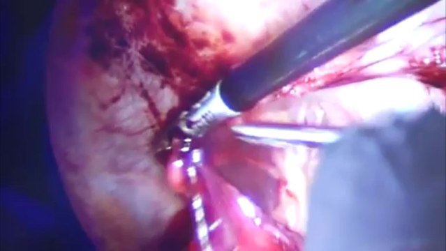 Hernia repair laparoscopic method