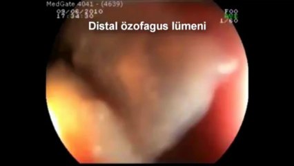 Kayıhan Günay  Özofagus (Yemek Borusu) Rüptürü
