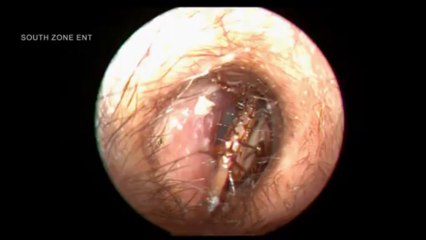 Cafard vivant dans l'oreille